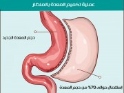 خاص بالفيديو|| عملية تكميم المعدة بالمنظار - ما هي ؟